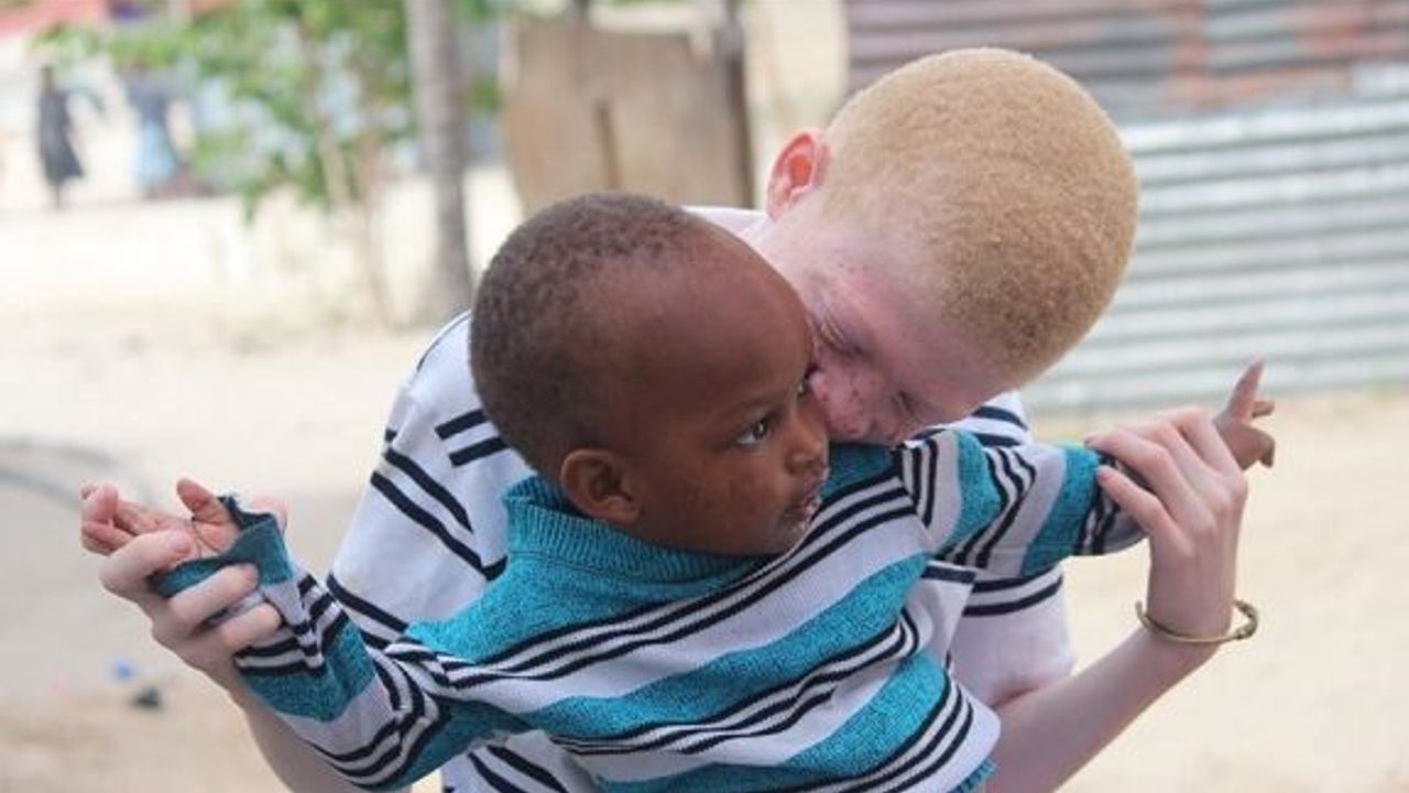 Afrikalı Albinolar 'Beyaz' Bir Gelecek Ümidiyle Yaşıyor