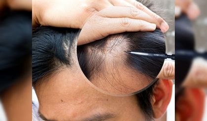 Tabipler Birliği: Çalışma izni olmadan saç ekimi yapanlar tespit edildi!